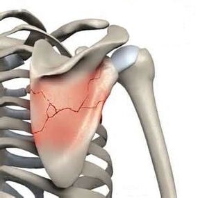 Fractured scapula is one of the causes of severe pain