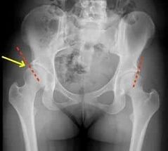 methods of treating arthrosis of the hip joint