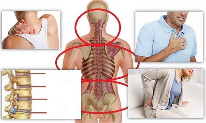 places of disease in osteochondrosis